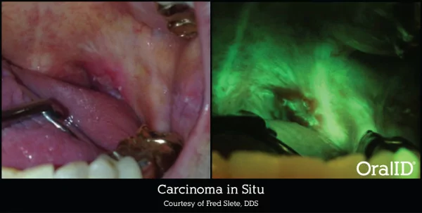 oral cancer screening light