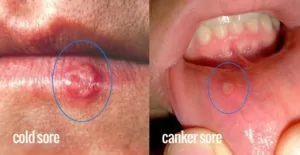 cold sore, canker sore, laser therapy, cold sore treatment with laser